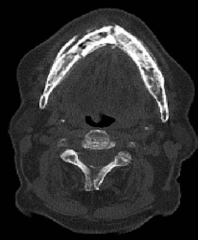 Nízkodávkové nativní CT v rámci SPECT/CT vyšetření u pacienta z obr. 1, axiální řez – nehomogenní struktura celé dolní čelisti se sklerotickými okrsky, osifikovaná periostální reakce na zevní i vnitřní ploše mandibuly. Oproti OPG jsou patrné 2 lomné linie – v symfýze a v těle mandibuly vpravo ad 45. (Zdroj obr.: Klinika zobrazovacích metod LF UK a FN
Plzeň)
