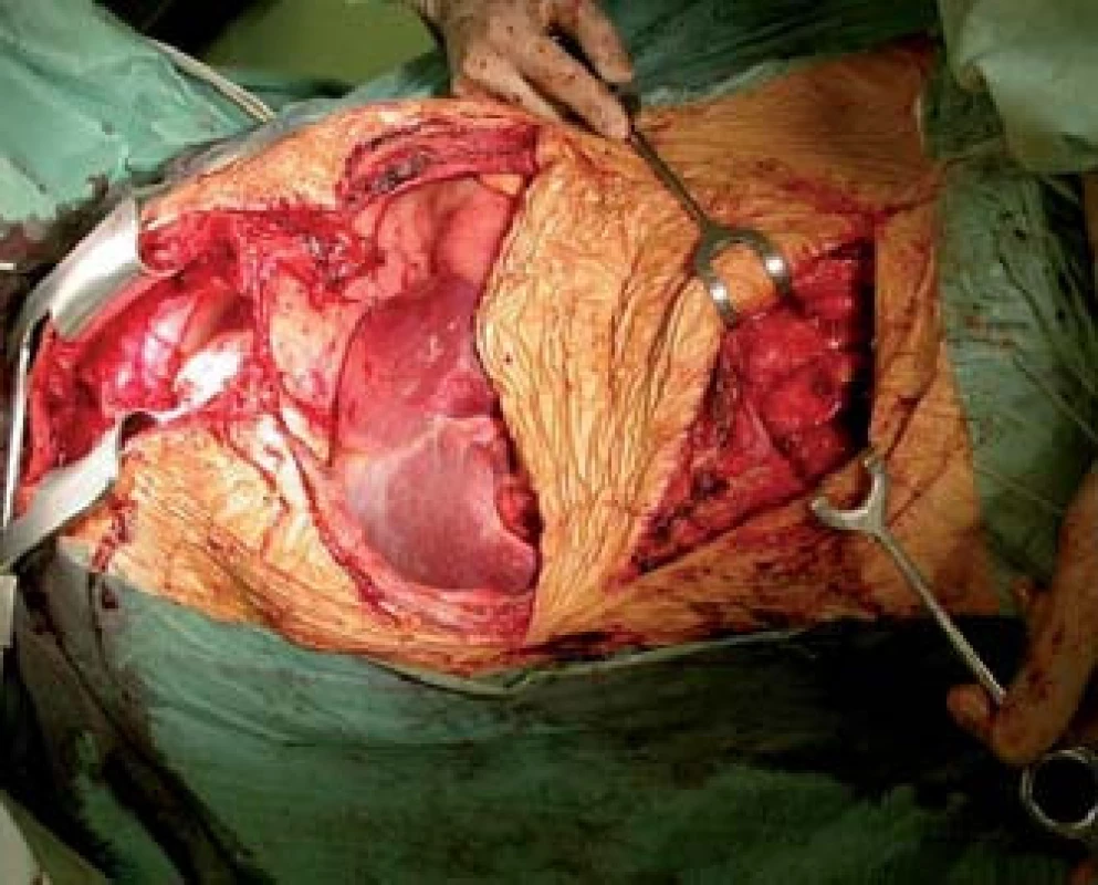Kombinovaná transplantace srdce, jater a ledviny.