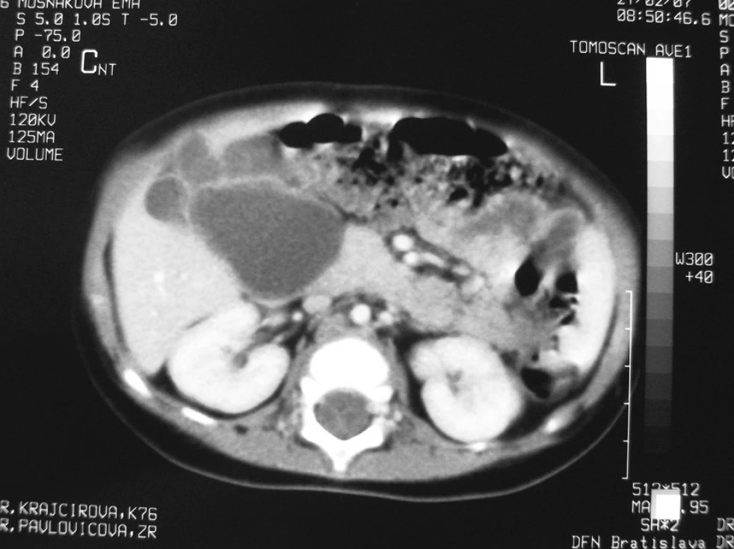 CT – multicystické ložiská v pečeni
Fig. 1. CT scan – multicystic lesion’s in the liver