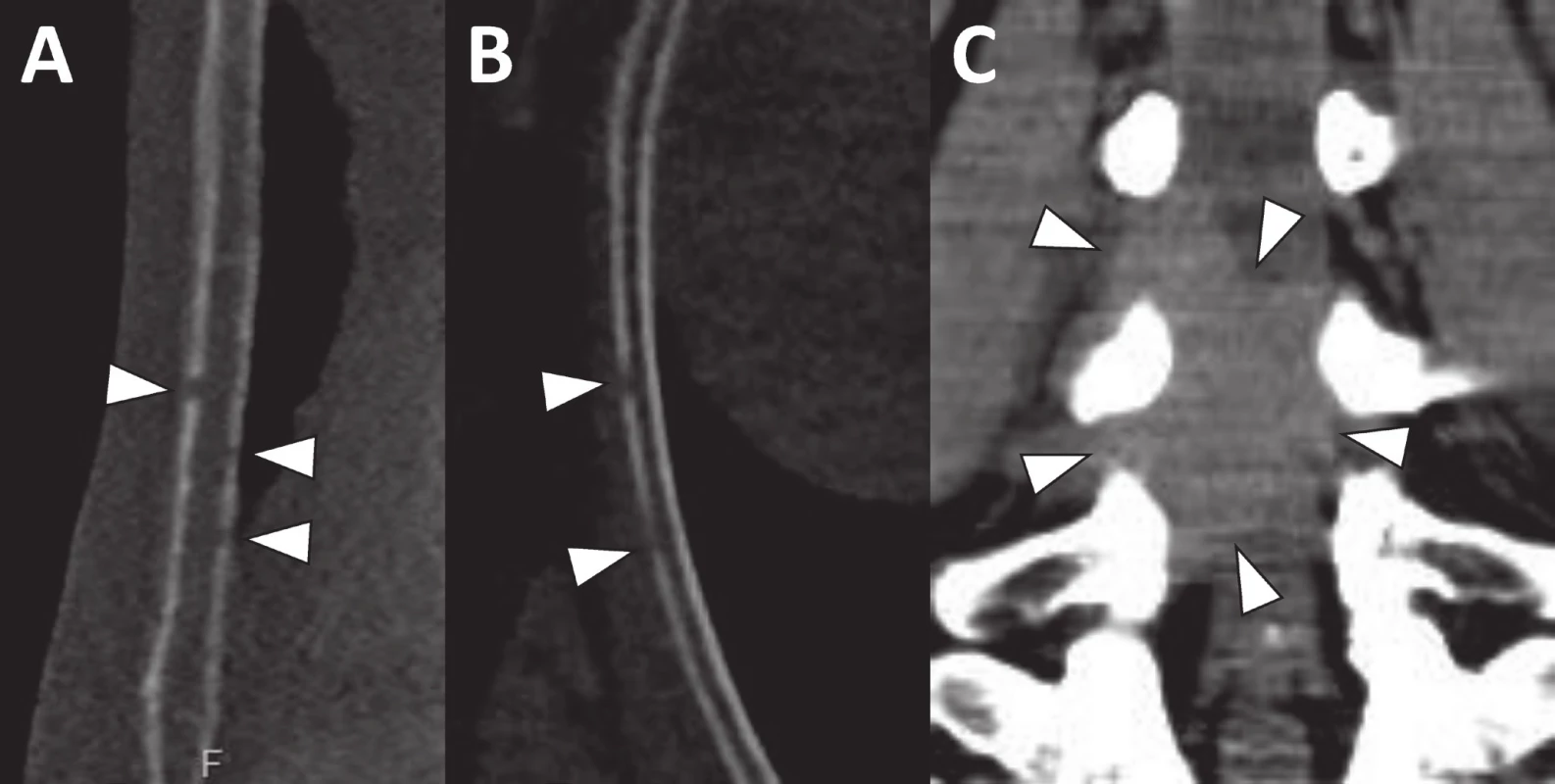 Drobná osteolytická ložiska ve sternu (a) a žebru (b) velikosti 1–2 mm jsou díky velkému denzitnímu rozdílu mezi kortikou a měkkou tkání s jistotou detekovatelná i na CT vyšetření provedeném se srovnatelnou radiační zátěží jako RTG
Na CT se rovněž zobrazila měkkotkáňová formace zasahující do páteřního kanálu v bederní oblasti (c).