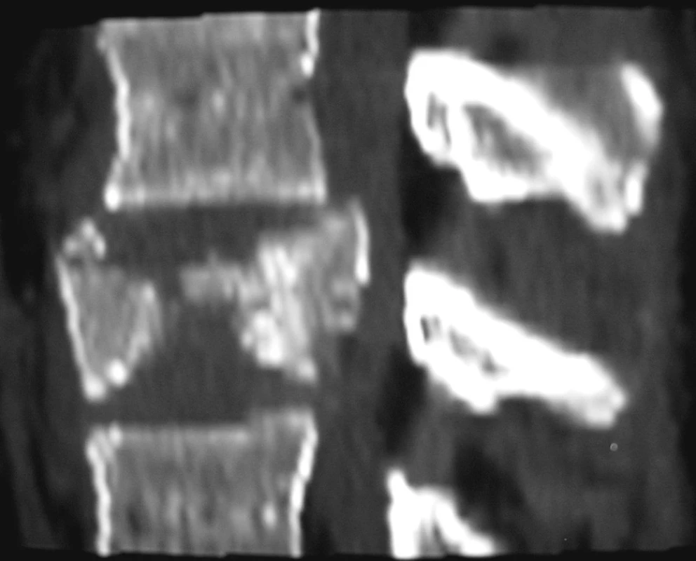 Bočná CT rekonstrukce pincer zlomeniny obratlového těla typ A2.3
Pic. 1. Lateral CT reconstruction of the pincer vertebral body fracture, type A2.3