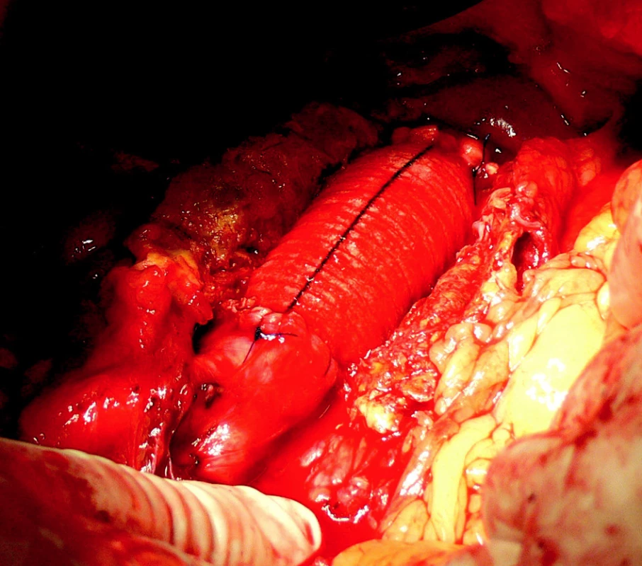 9. Resekce AAA s A-A náhradou ze střední laparotomie
Fig. 9. Resection of the AAA with A-A implantation performed via the midline incision