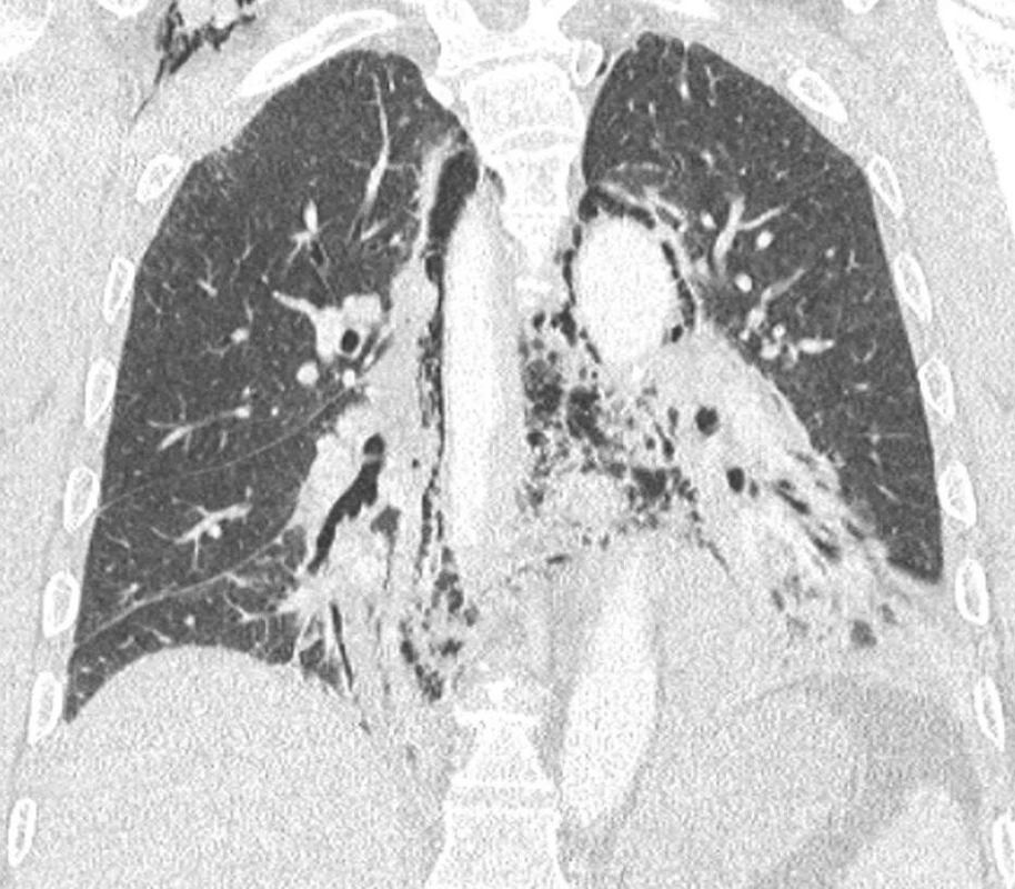 Koronární CT obraz v plicním okénku ukazující na rozsah pneumomediastina
Fig. 8. Coronary CT view (lung window) showing the extent of the pneumomediastinum