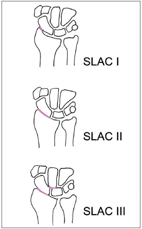 SLAC wrist – barevně označen rozsah degenerativních změn.