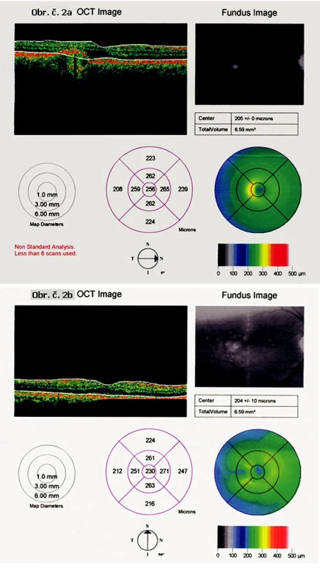 Obr. 2. OCT, OP oka pacienta z obr. 1
Obr. 2A: OCT prokazuje RPED zobrazené na obr. 1A před léčbou.
Obr. 2B: OCT téhož oka po léčbě demonstruje přiložení RPED a obnovu normálního optického průřezu makuly