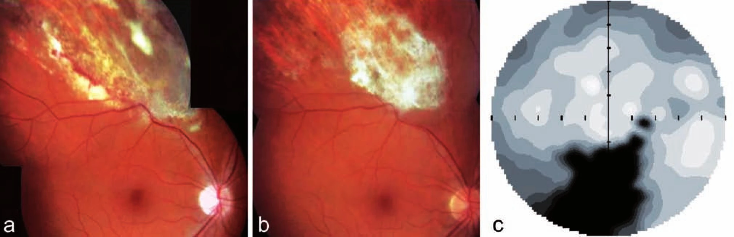 Klinický nález u pacienta z kazuistiky 2. Fotografie dokumentuje bělavá již resorbující se ložiska infiltrace a hemoragie s atrofizací sítnice v horním nazálním kvadrantu pravého oka u pacienta na celkové imunosupresi (Medrol + Cyklofosfamid) pro ulcerózní kolitidu a), klidná jizva pro proběhlé CMV retinitidě b), statická automatická perimetrie pravého oka s odpovídajícím výpadem v zorném poli c)