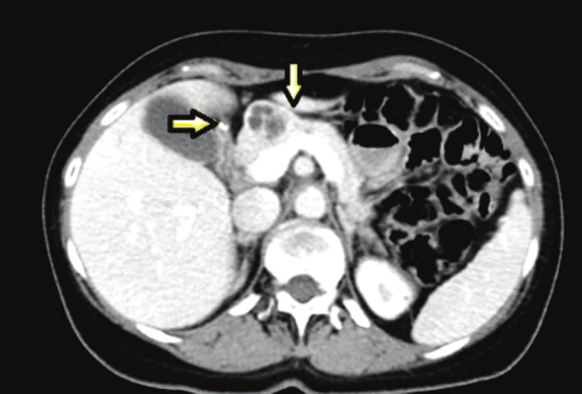 Léze v oblasti pankreatu a duodena
Fig. 3: Pancreatic and duodenal lesions
