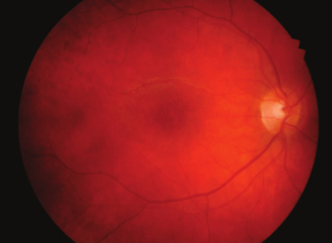 Téměř úplná resorpce hvězdicové makulopatie pravého oka 2 měsíce po léčbě