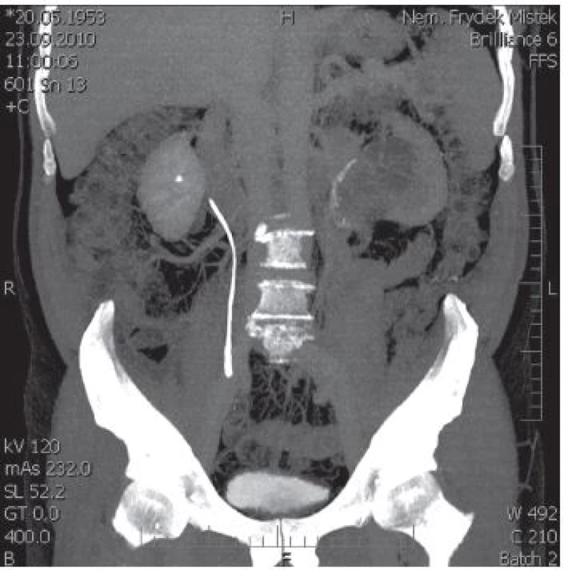 CT + IVU s afunkcí levé ledviny a osifikací stěny pánvičky
Fig. 1. Afunctio of the left kidney with calcification of pelvis wall on CT + IVU
