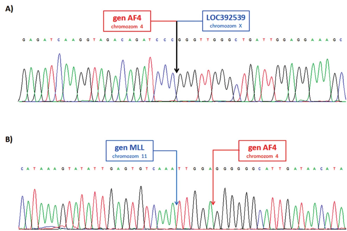 Sekvence LR-PCR produktů A) derivovaný chromozom 4; fúze genu AF4 (intron 5) a pseudogenu LOC392539 na chromozomu X. B) derivovaný chromozom 11; fúze genů MLL (intron 9) a AF4 (intron 5).