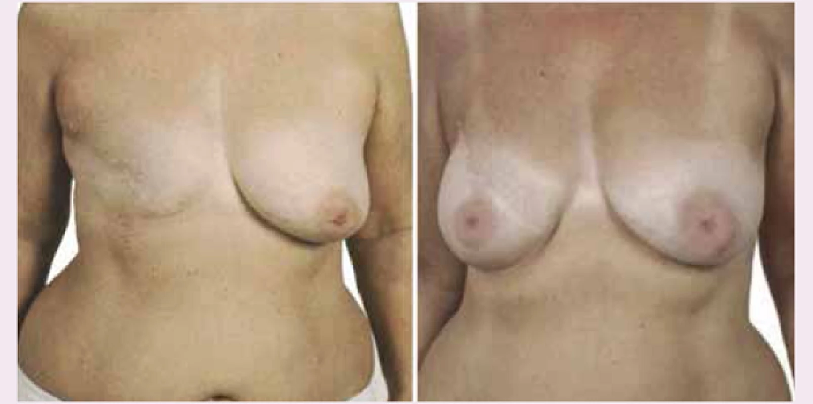 Rekonstrukce prsu implantátem