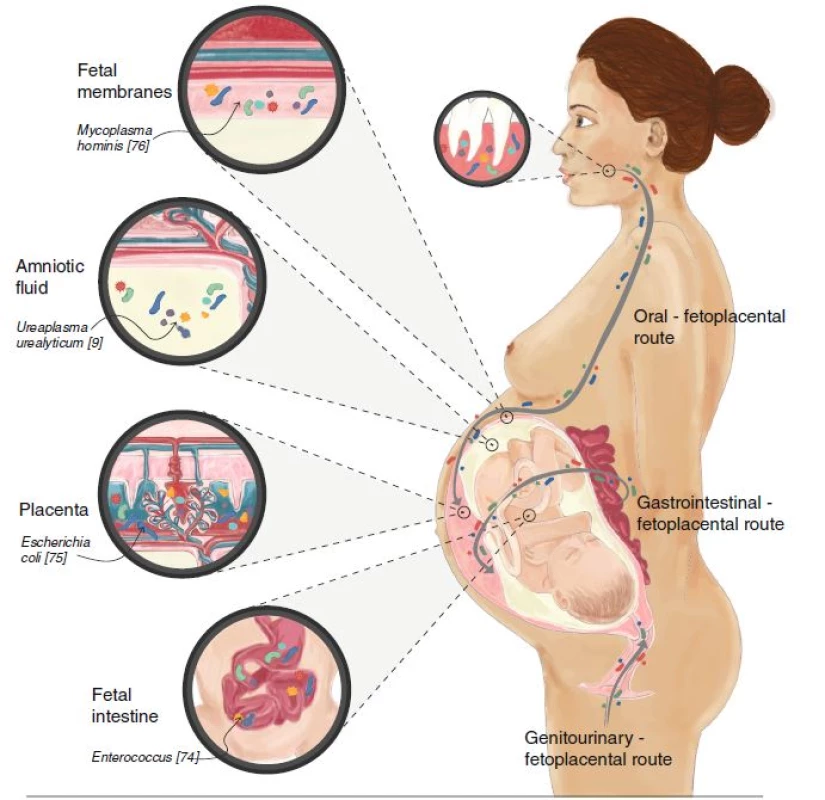 The fetoplacental microbiome of healthy pregnancy and its origins. Bacteria and their genes have been isolated from human placentas, amniotic fluid, fetal membranes, and fetal gastrointestinal tract in healthy, normal pregnancies. These bacteria have three main routes of entry: the oro-fetoplacental route, the gastrointestinal-fetoplacental route, and the genitourinary-fetoplacental route. Examples of specific bacteria are indicated