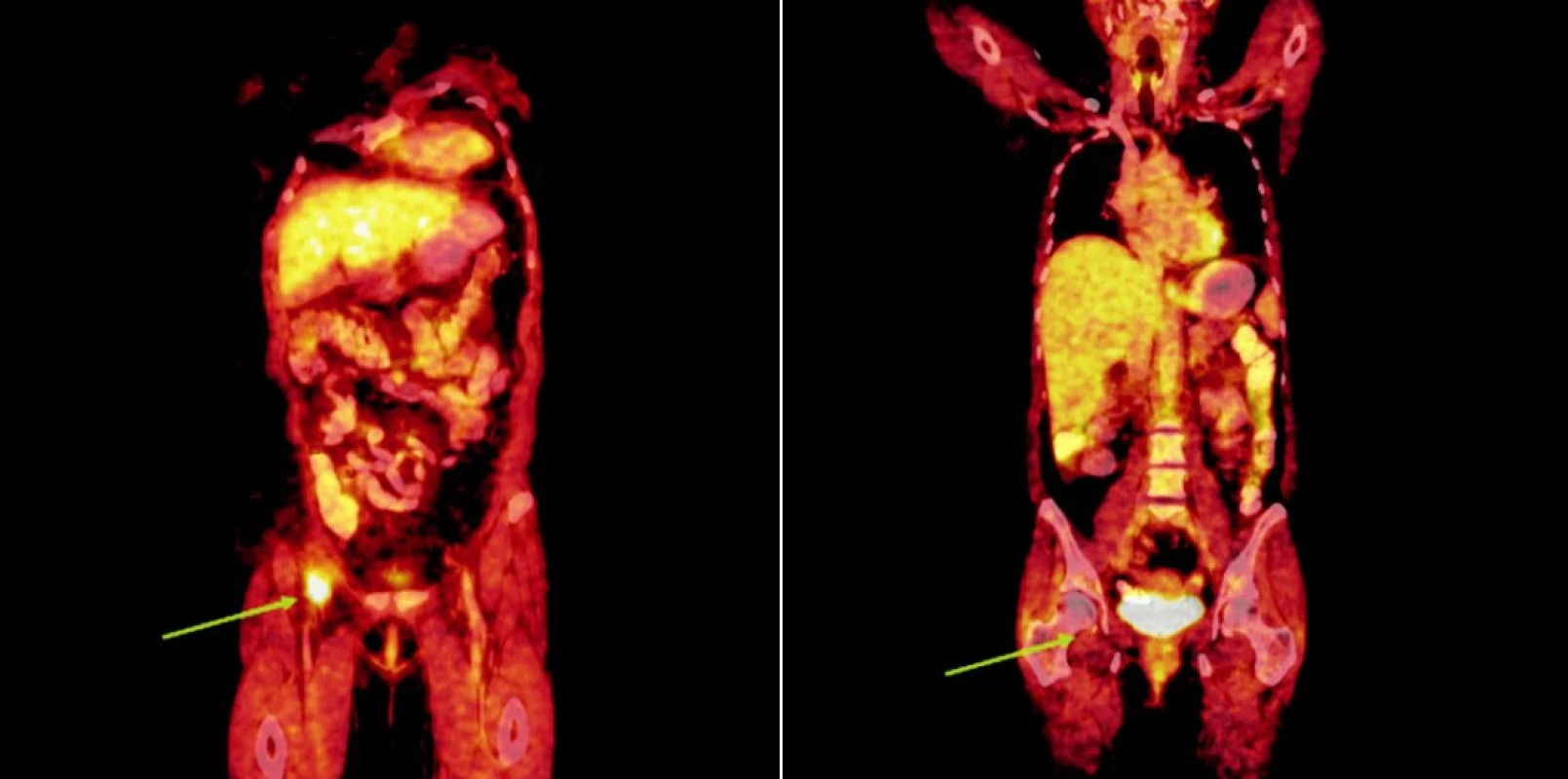 Srovnání snímků integrované pozitronové emisní tomografie (s použitím 18F-fluoro-deoxy-glukózy) a počítačové tomografie při relapsu (a) a po skončení léčby 90Y-ibritumomab tiuxetanem (b) u druhého pacienta s folikulárním lymfomem.