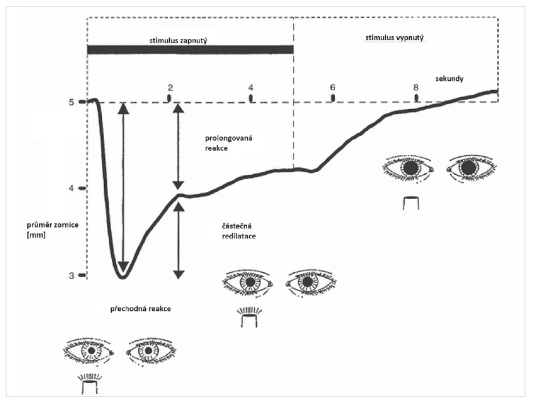 Pupilografický záznam pupilární reakce na jasný, bílý, světelný stimulus o délce 5 sekund u zdravého člověka. Pupilární reakce se skládá ze dvou fází. Po zapnutí stimulu dochází k rychlé, maximální pupilární konstrikci s krátkou latencí (přechodná fáze pupilární reakce na osvit). Poté se zornice poněkud rozšíří (částečná redilatace) do stadia částečného zúžení zornice, které reprezentuje prolongovanou fázi pupilární reakce na osvit a přetrvává i po vypnutí stimulu. (Modifikováno podle reference 16)