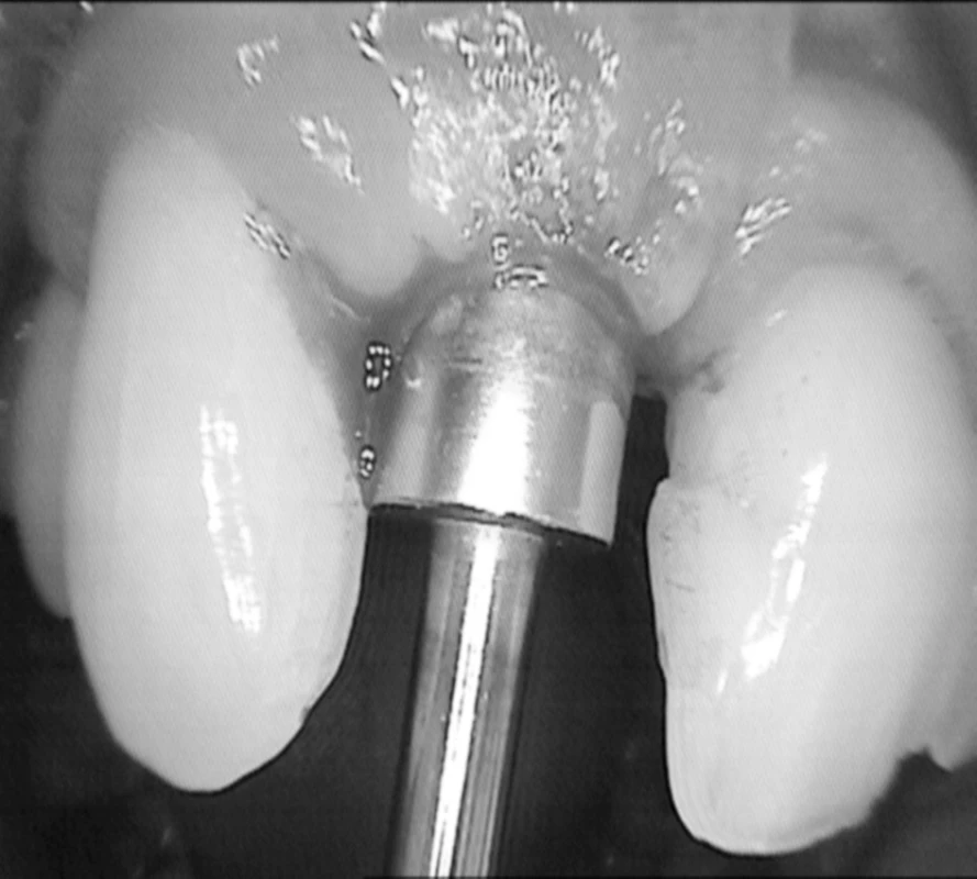 Obnaženie oseointegrovaného implantátu cirkulárnym vykrajovačom. (Foto: Eurodent medima, s.r.o.).