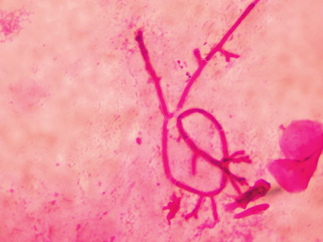 Aspergilová vlákna v bronchoalveolární tekutině, barvení podle Grama (foto autorka)
Figure 2. Aspergillus filaments in Gram stained bronchoalveolar lavage fluid (photo by the author)