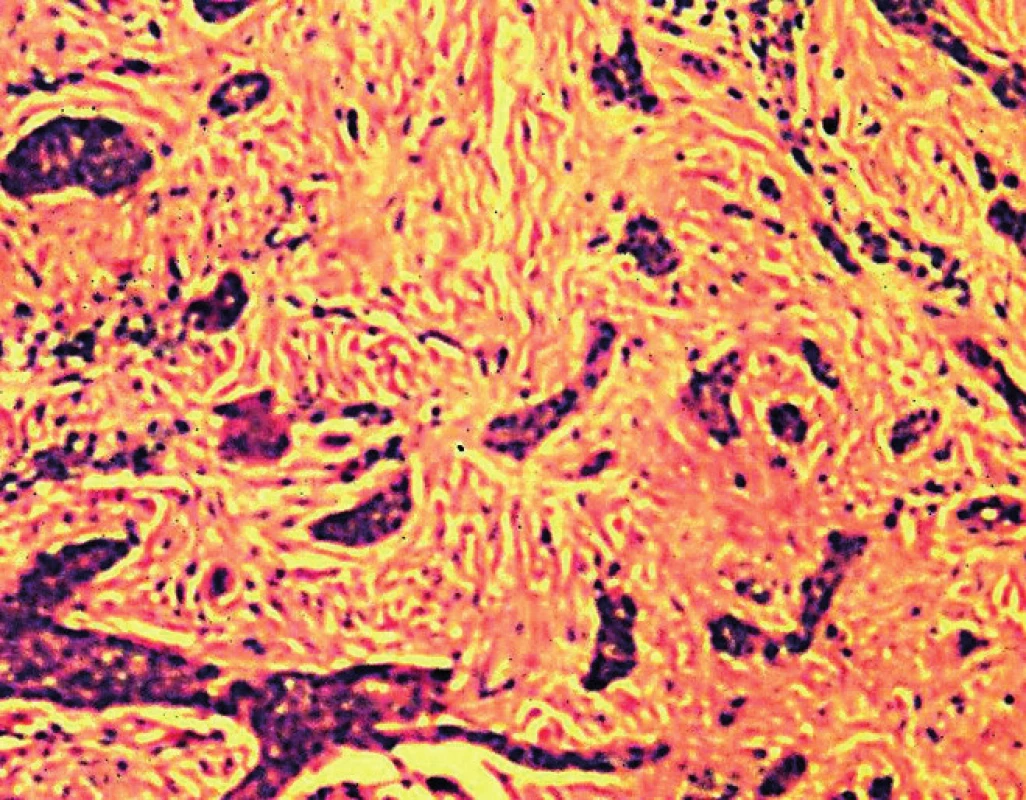 Infiltratívny BCC – neohraničené a invazívne rastúce pruhy nádorových buniek infiltrujúce dermu (H&amp;E, 100x)