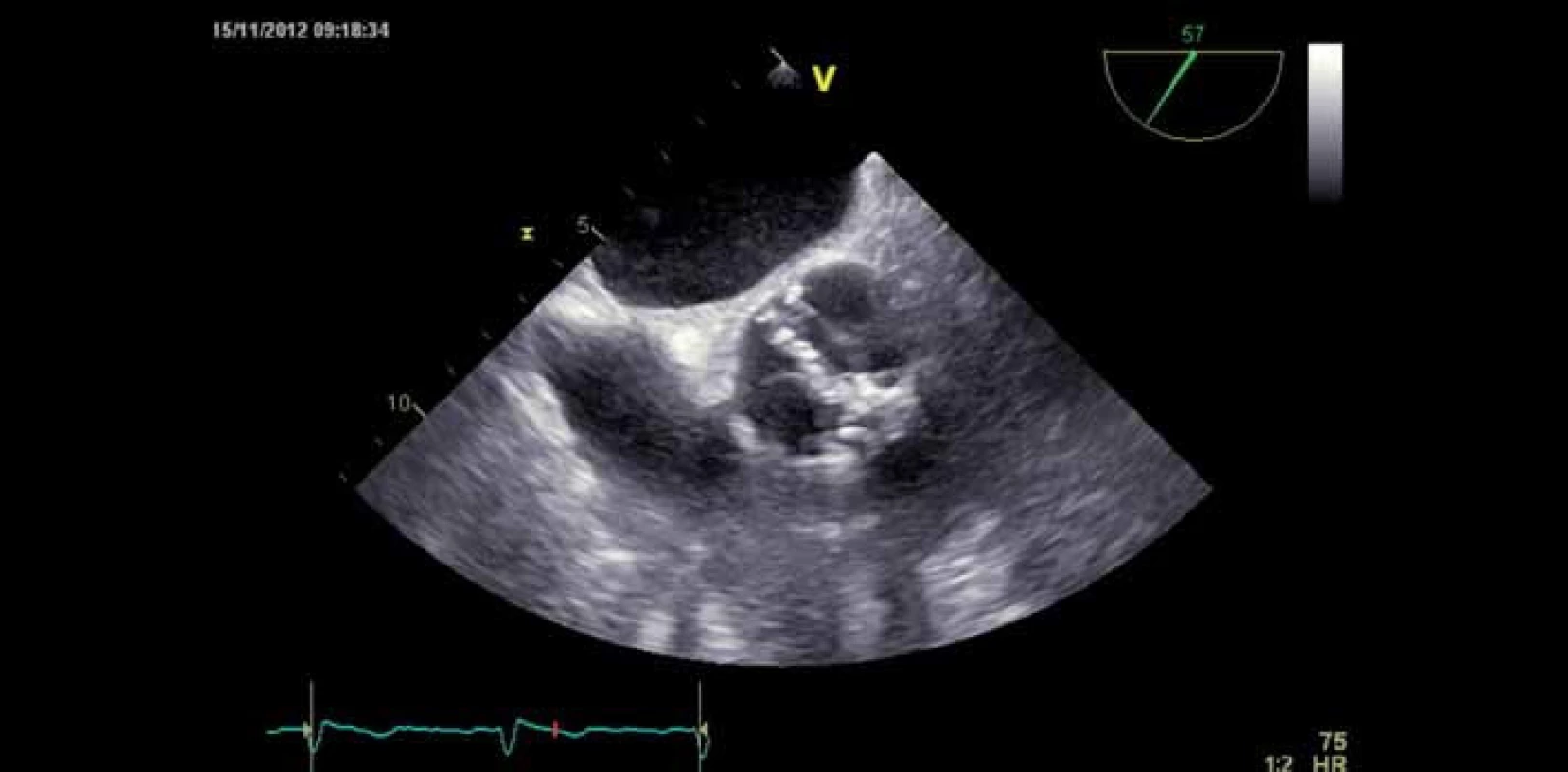 Bikuspidální stenotická aortální chlopeň – jícnová echokardiografie.