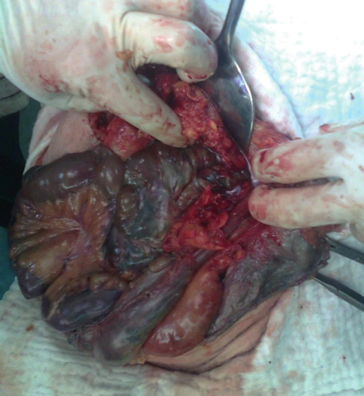 Operační foto
Fig. 5: Surgical picture