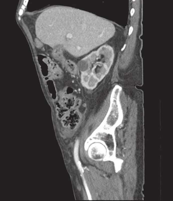 CT obraz – cholecystokolická píštěl
Fig. 3: Cholecystocolonic fistula (computed tomography finding)