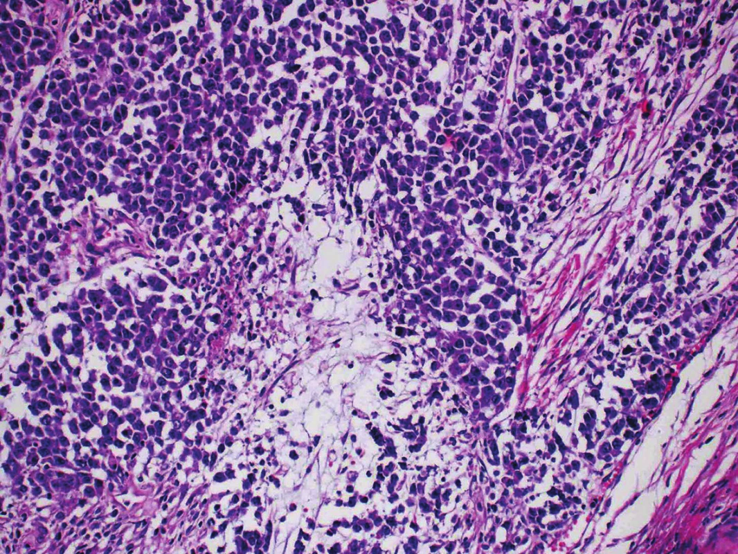 Undifferentiated component consisting of dyscohesive atypical cells arranged in sheets. (H&amp;E, original magnification 400x).