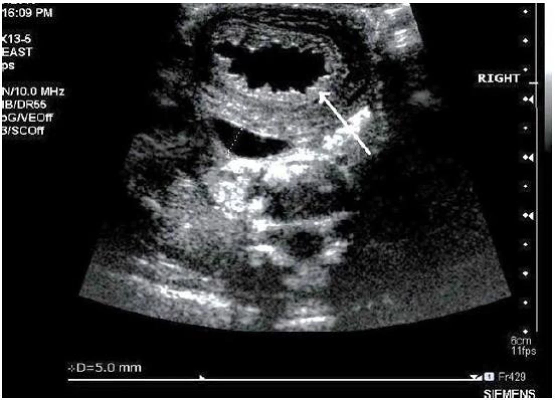 Ultrasonografie, pacient č. 13; šipka ukazuje na zesílenou a trabekulizovanou stěnu močového měchýře, jeho obsah je čirý; juxtavezikálně zobrazený ureter má šířku 5 mm (tečkovaně).

Fig. 3. Ultrasound, patient No 13; note thick and trabeculated bladder wall with content of clear urine (arrow); diameter of juxtavesical ureter is 5 mm (dotted line).