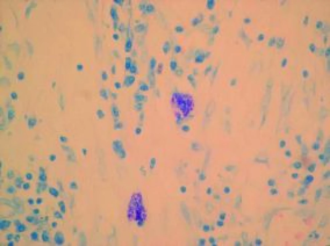 Granulomatózní zánět, množství gigantických buněk, bezbičíkaté parazitární formy v makrofázích (Giemsa).