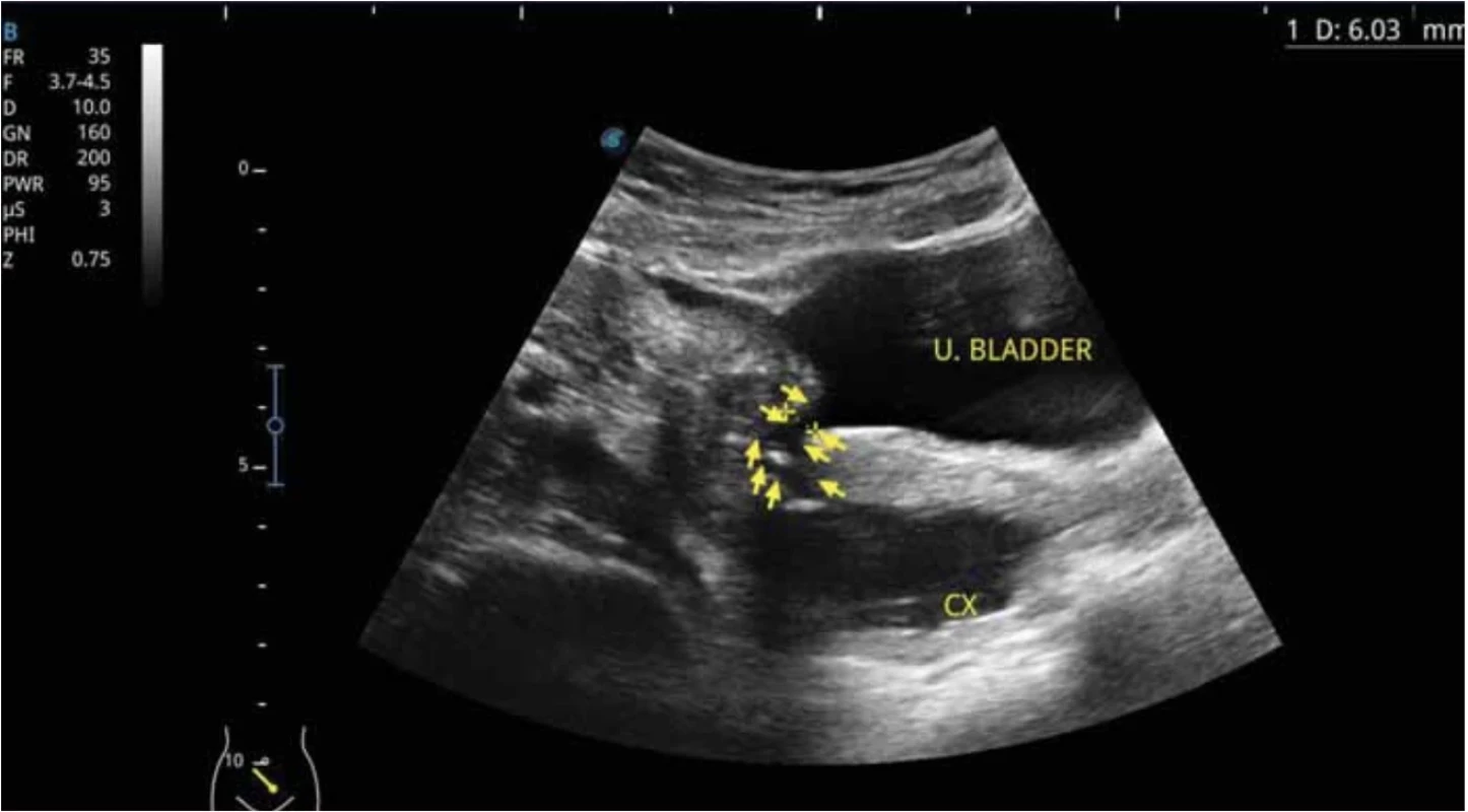 Yellow arrows show the uterovesical fistula tract, CX – cervix and U – urinary bladder (published with the patient's permission). //  Žluté šipky znázorňují trakt uterovezikální píštěle, CX – děložní hrdlo a U – močový měchýř (publikováno se svolením pacientky).