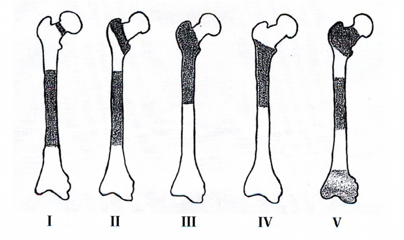 Naše klasifikace ipsilaterálních zlomenin horního konce a diafýzy femuru