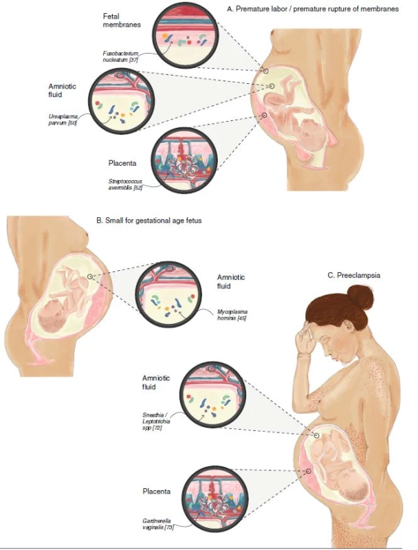 The fetoplacental microbiome in various pregnancy complications involving the placenta. Examples of specific disease-associated species are shown. a Bacteria are found in the placenta (Streptococcus avermitilis), fetal membranes (Fusobacterium nucleatum), and amniotic fluid (Ureaplasma parvum) in cases of premature labor and premature rupture of membranes. b Bacteria are present in amniotic fluid (Mycoplasma hominis) in small-for-gestational-age (intrauterine growth restriction) fetuses. c Bacteria are present in the placenta (Gardnerella vaginalis) and amniotic fluid (Sneathia/Leptotrichia spp) in cases of preeclampsia. A pregnant woman is illustrated, exhibiting headache, edema, and petechia