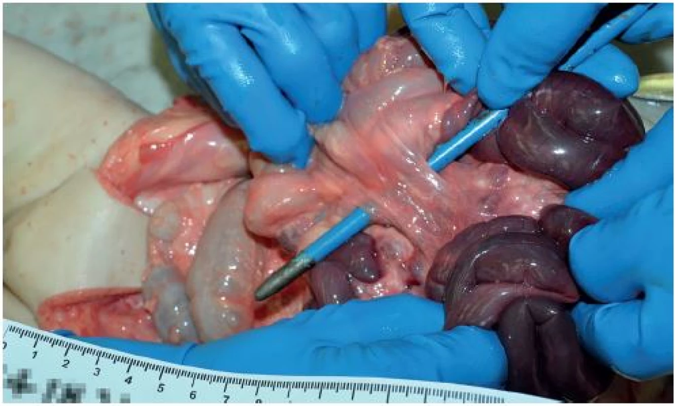 Detail nálezu v dutině břišní u 5,5měsíční dívky. Úzký závěs tenkého střeva a vzestupného tračníku s cévním zásobením cestou arteria mesenterica superior.