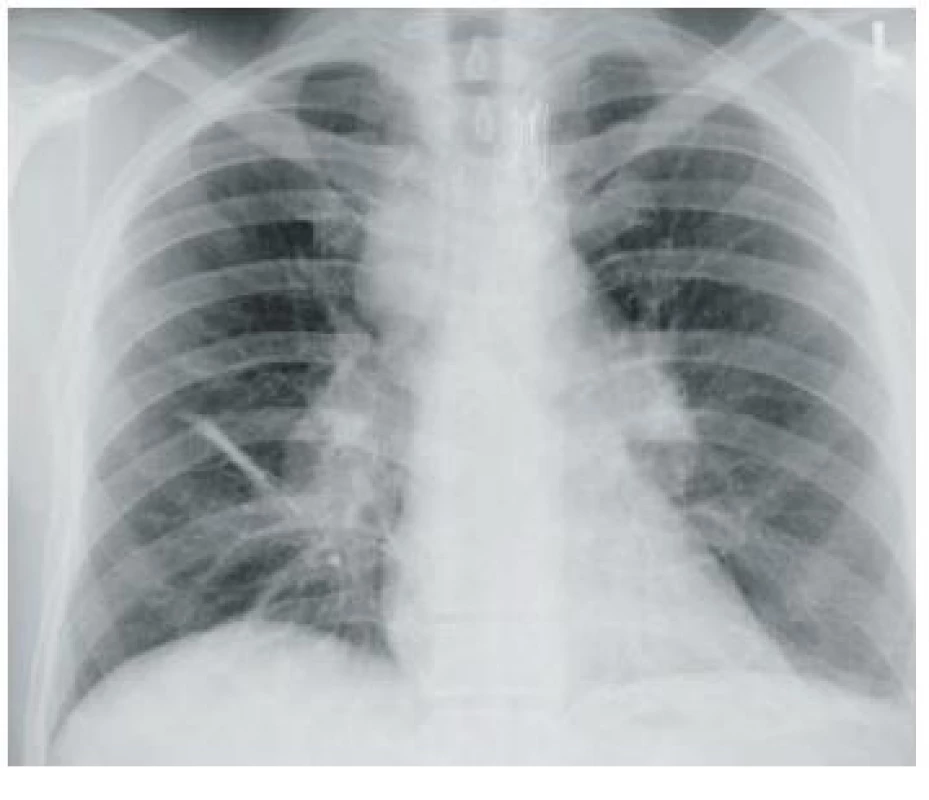 Uzlinami zvětšené oba plicní hily a vpravo paratracheálně v mediastinu