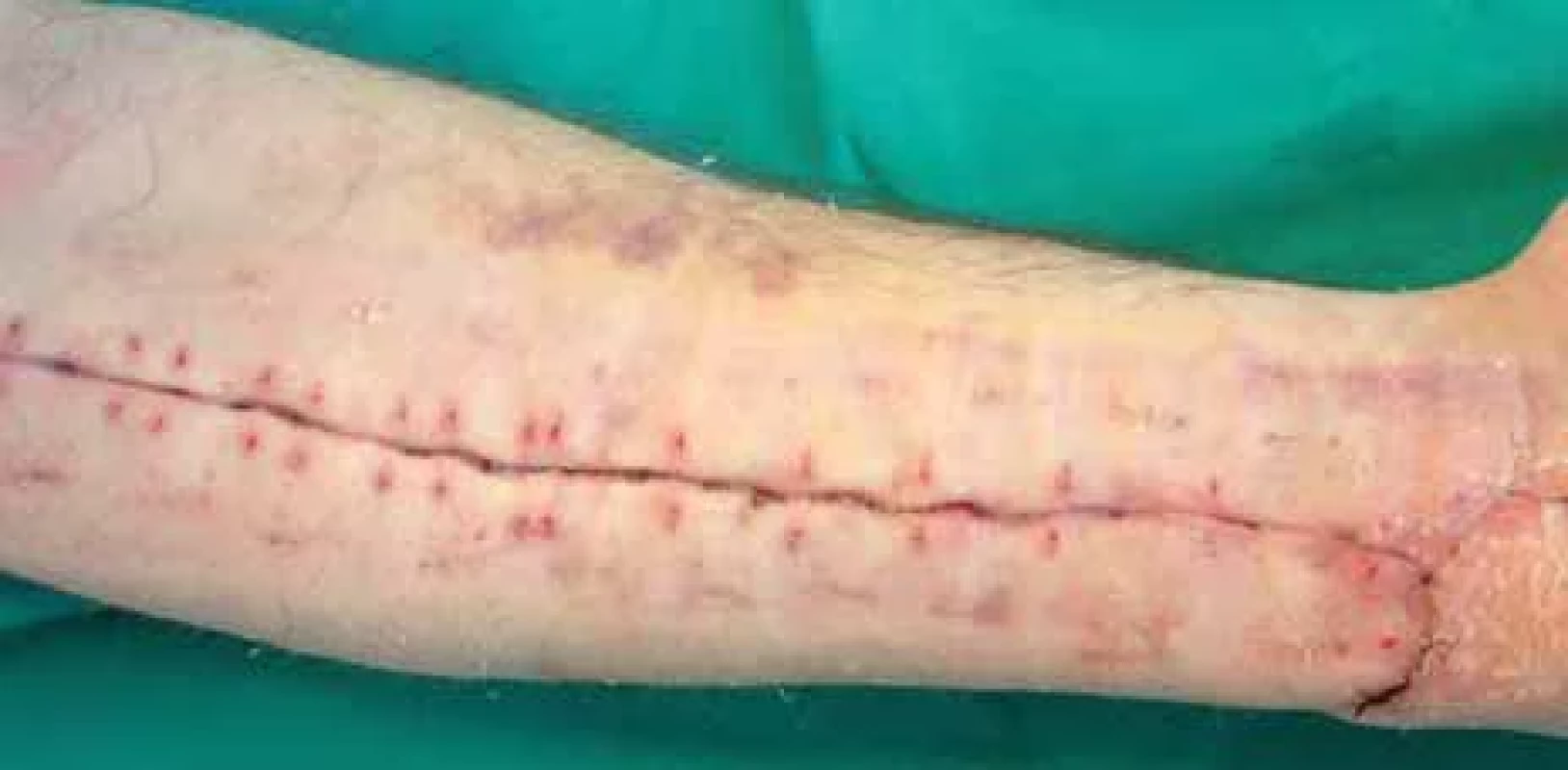 Left forearm fasciotomy wound after removal of skin staples.
