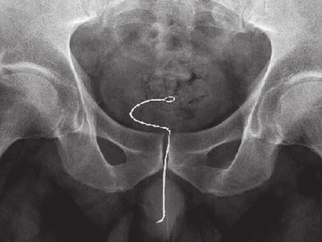 Cínový drát zavedený v mužské močové trubici zasahující do močového měchýře (A), prostý snímek pánevní oblasti (B)
Fig. 2. A – plain fi lm cystography, tin wire self-inserted in the male urethra and urinary bladder (B)