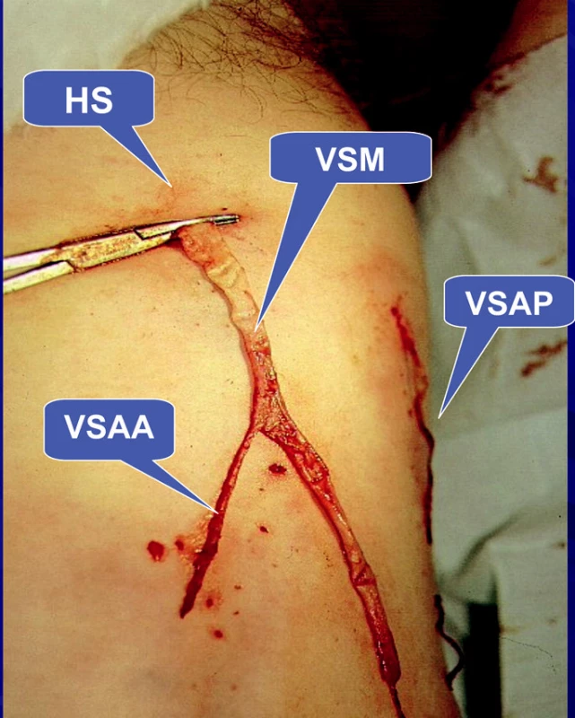 Safénový komplex typ II. Intrafasciální flebektomie celého safénového komplexu – VSM a z ní odstupující VSAA v oblasti HS probíhá mimo HS, nad fascia musularis má svůj samostatný průběh