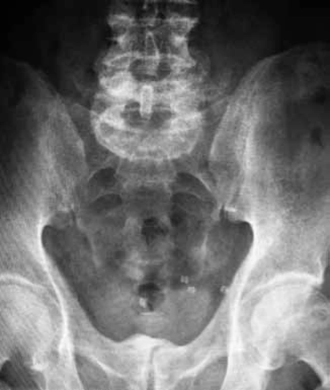 Nativní snímek břicha
Fig. 1. Abdominal X-ray