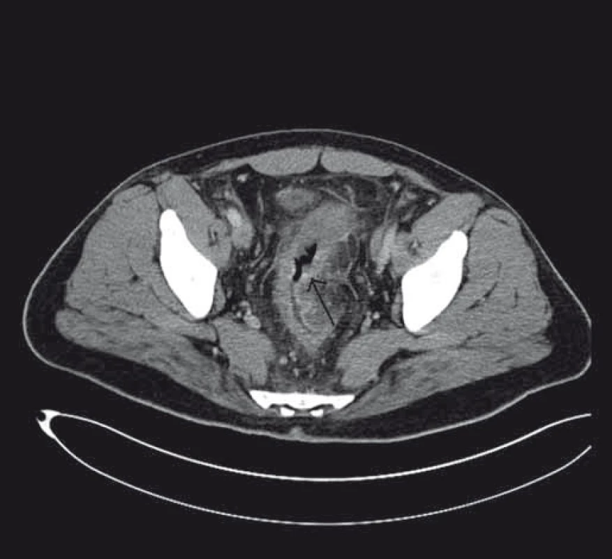 Stenóza střeva při CT zobrazení.
Fig. 2. Stenosis of the bowel on the CT scan.