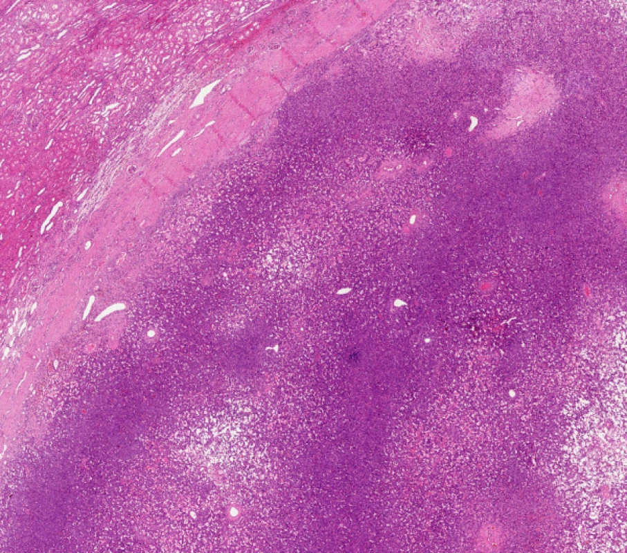 Nádor z juxtaglomerulárních buněk ledviny – přehled, HE, 40krát