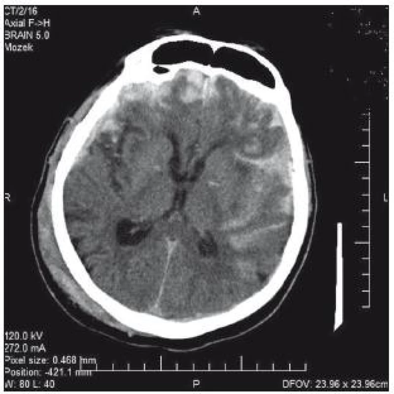 CT mozku: progrese kontuzí frontobazálně vpravo a subarachnoidálního krvácení vlevo temporálně v odstupu 3 hod od úrazu.
