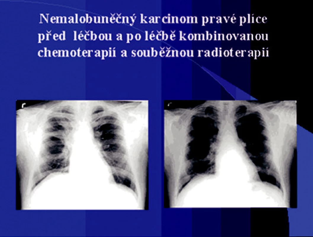 Nemalobuněčný karcinom pravé plíce před léčbou a po léčbě