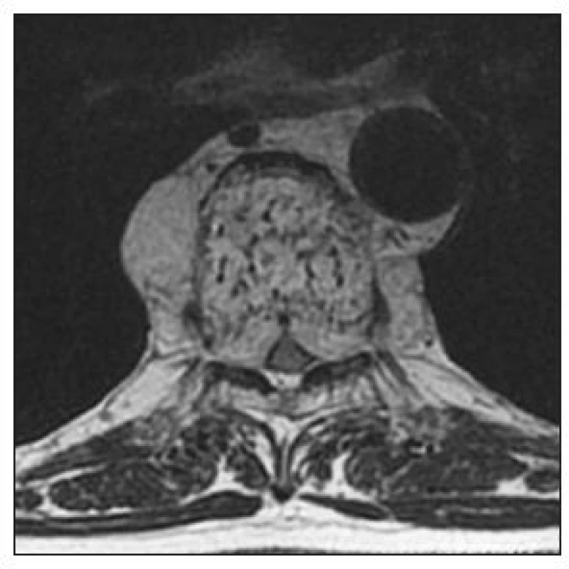 MRI (T2-vážené) v axiální rovině. Průkaz hemangiomu obratle Th7 s propagací paravertebrálně a do kanálu
páteřního
Fig. 2. Axial MRI (T2-weighted). Detection of hemangioma of TH7 with paravertebral spread into the spinal canal
