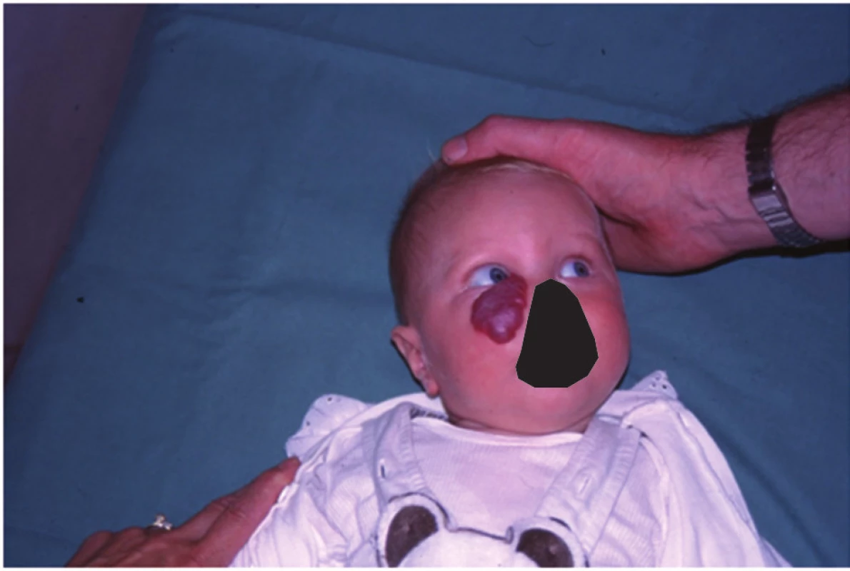 Kapilární hemangiom dolního víčka u šestiměsíčního kojence