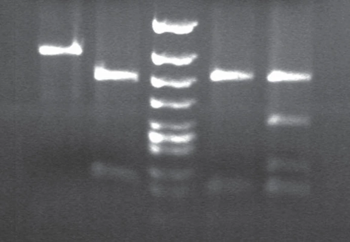 BsmA1 and HpyCHIV restriction patterns in gCJD patient homozygous for the mutation E200K.