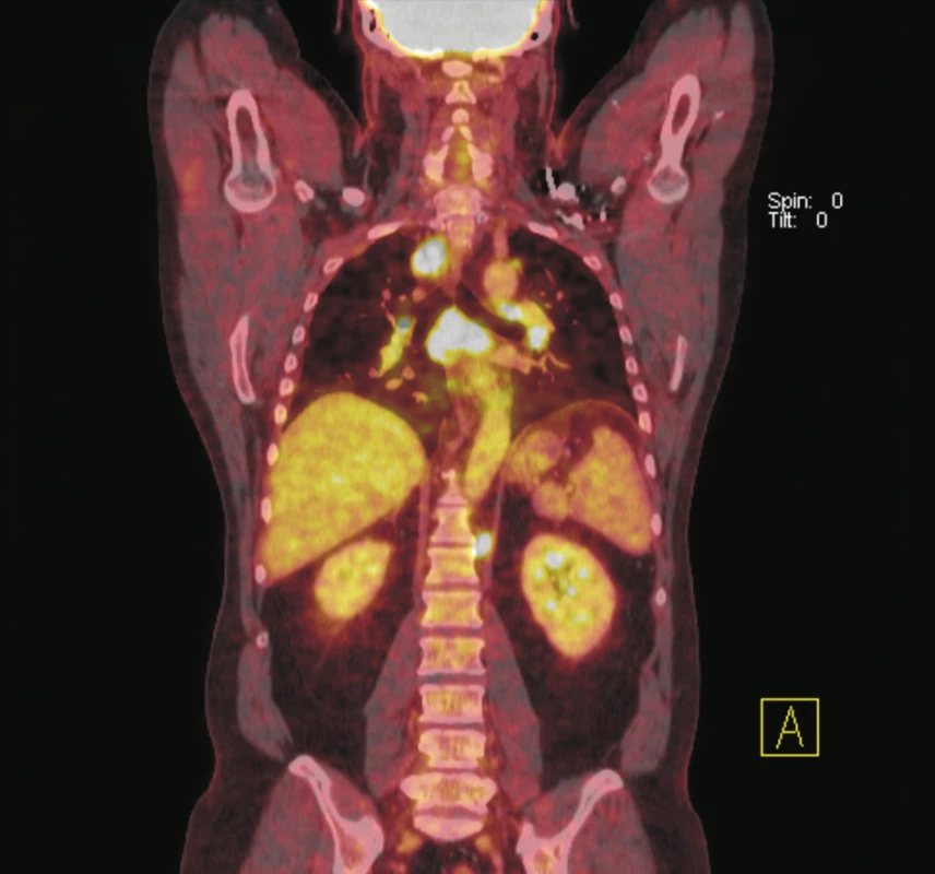 Na fúzovaném koronálním PET/CT řezu lze diferencovat zvýšenou akumulaci &lt;sup&gt;18&lt;/sup&gt;F-FDG v lymfatických uzlinách mediastina paratracheálně vpravo, oboustranně bronchopulmonálně, v paketu uzlin subkarinálně a v retroperitoneu v lymfatické uzlině paraaortálně vlevo pod brániční krurou. Vícečetné postižení lymfatických uzlin bylo i v dalších lokalizacích, které nejsou na tomto řezu zastiženy. Biopticky prokázána sarkoidóza.