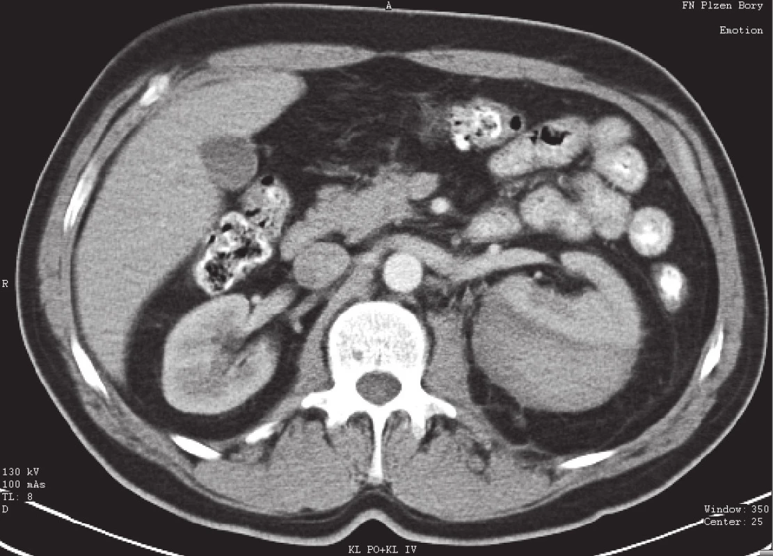 Subkapsulární hematom levé ledviny – I. stupeň poranění dle AAST
Fig. 1. Subcapsular haematoma of the left kidney – grade I. renal injury by AAST