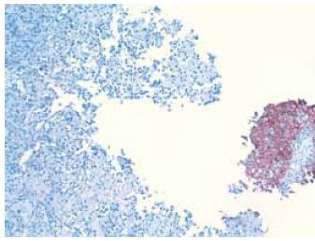 Imunohistochemický dôkaz cytokeratínu typ 7 v epitelovej zložke v pravej časti, osteosarkómový komponent vľavo je negatívny
Fig. 4. Immunohistochemical detection of cytokeratin type 7 in epithelial component on the right part of the picture, osteosarcomatous component in the left is negative