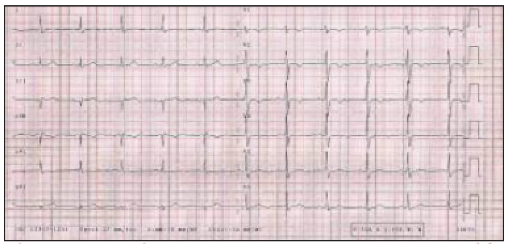 Elektrokardiografický záznam pacientky z 28. 2. 2003.