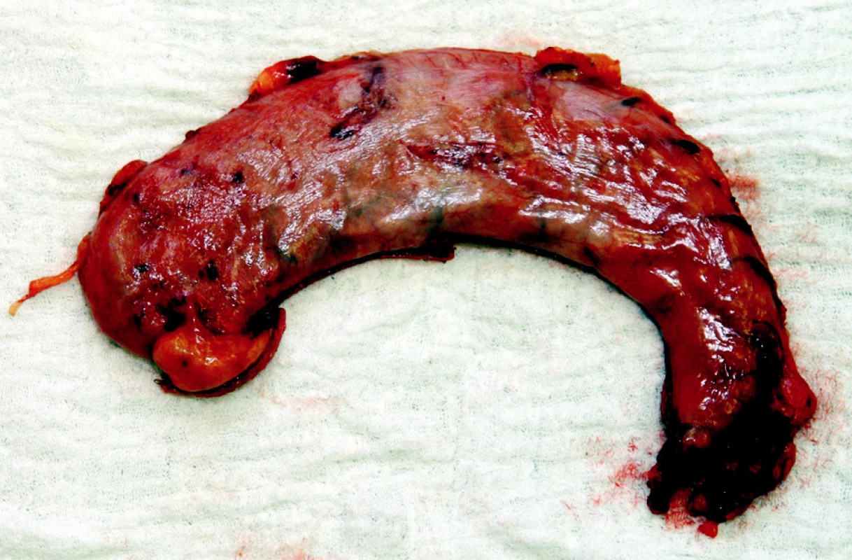 Resekovaná část žaludku
Fig. 5. Resected part of the stomach