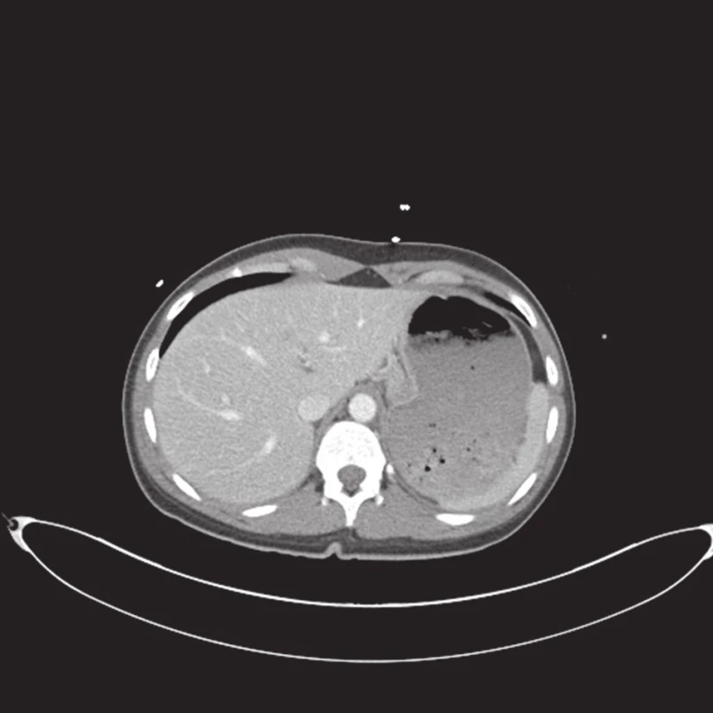 CT vyšetření při příjmu pacientky, bez známek poranění jater
Fig. 1. Initial CT examination, with no signs of liver injury