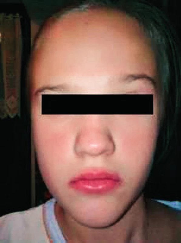 Angioedémy pier, nosa, exantém a asymetria tváre pacientky.
Fig. 1. Angioedema of lips and nose and exanthema with facial asymmetry in patient.